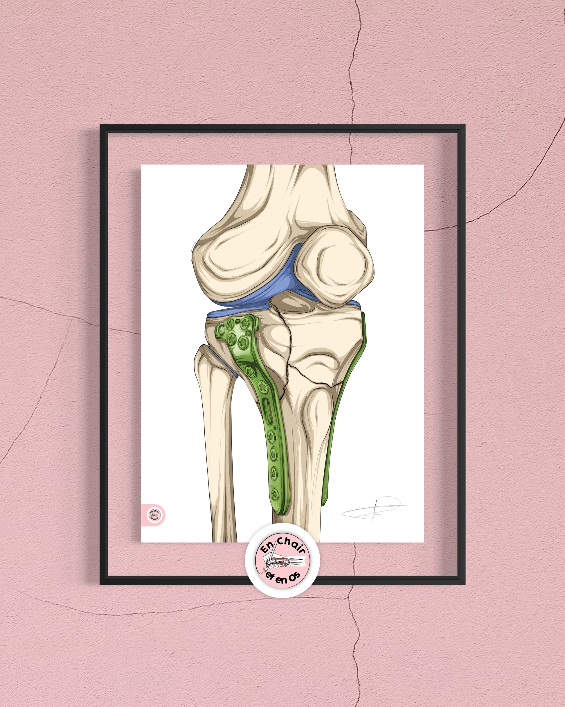 fracture plateau tibial avec plaque de synthèse